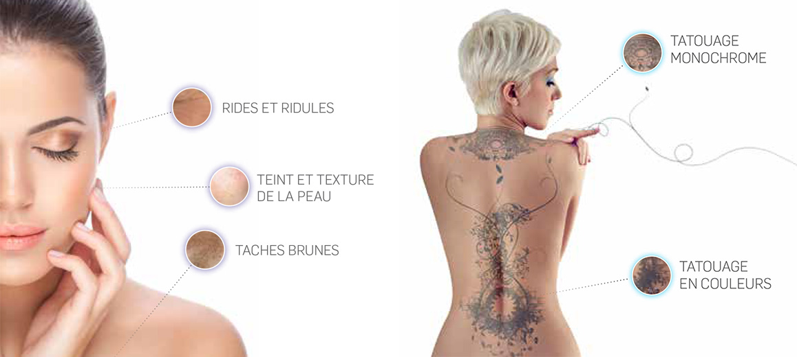 D&eacute;tatouage et photorajeunissement