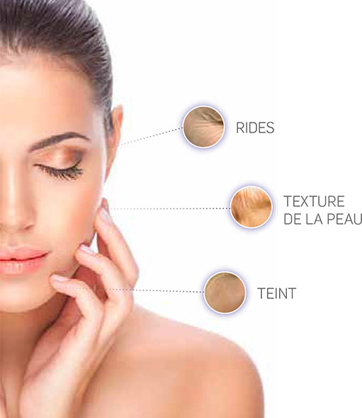 Indications de traitement du laser de remodelage fractionn&eacute;
