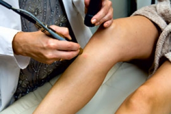 L&rsquo;&eacute;pilation d&eacute;finitive au laser &eacute;pilatoire