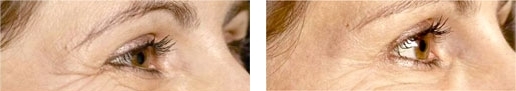 botox 1 botox 1