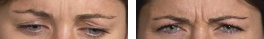 botox 2 botox 2