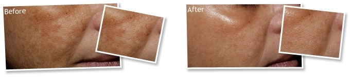 peeling peeling