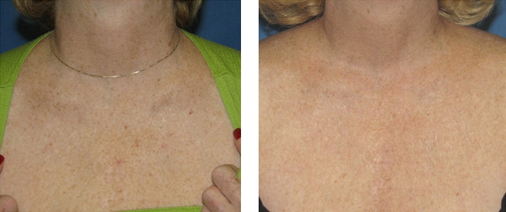 Taches pigmentaires d&eacute;collet&eacute;